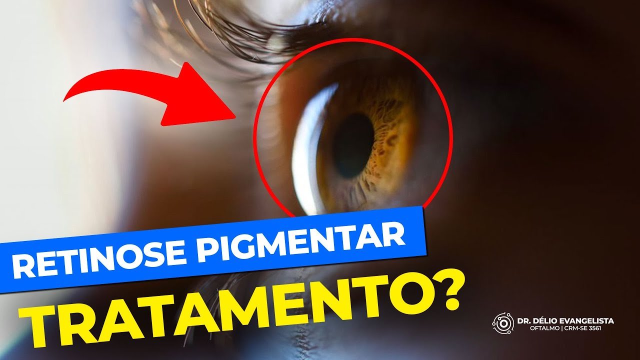 A Busca por Tratamento da Retinose Pigmentar