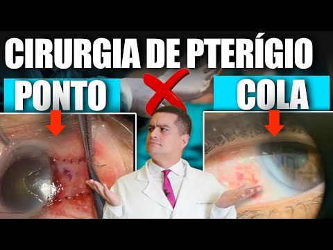 Cirurgia de Pterígio: Ponto x Cola