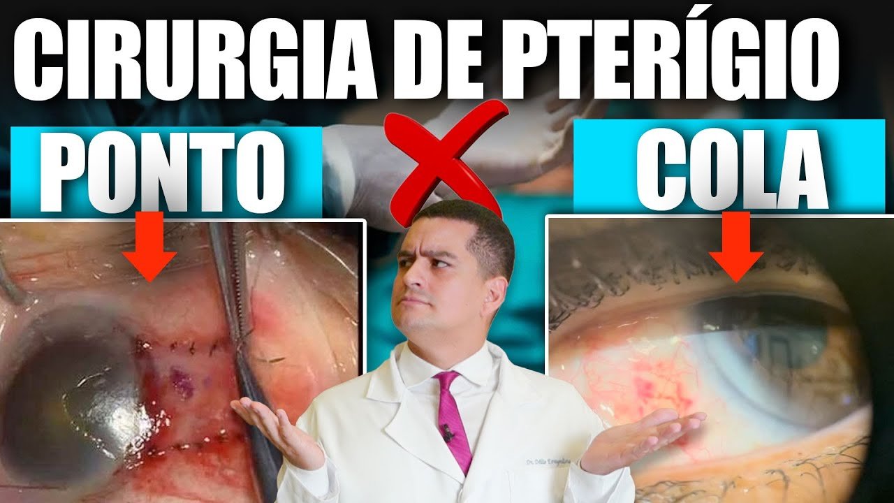 Cirurgia de Pterígio – Diferenças Entre Cirurgia com Ponto e com Cola Biológica