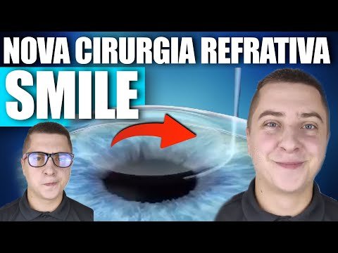 NOVA CIRURGIA REFRATIVA: SMILE