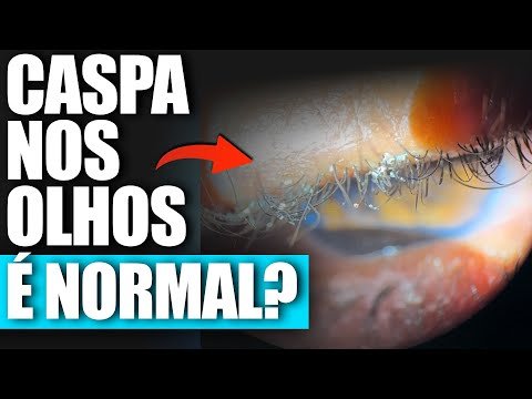 CASPA NOS OLHOS? (BLEFARITE) É NORMAL?