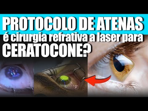PROTOCOLO DE ATENAS É CIRURGIA REFRATIVA A LASER PARA CERATOCONE?