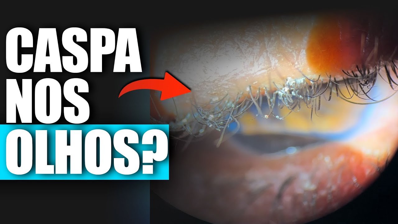 Caspa nos Cílios (Blefarite): Sintomas, Causas e Tratamentos