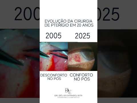 Evolução da cirurgia de pterígio