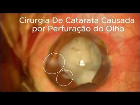 Cirurgia de Catarata Causada Por Perfuração do Olho