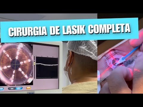 CIRURGIA REFRATIVA TIPO LASIK NA ÍNTEGRA