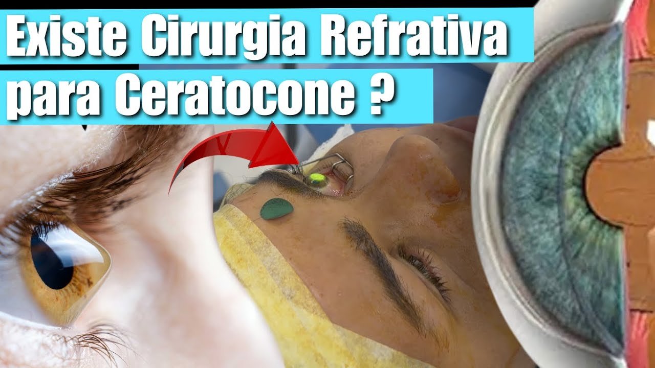Quem tem ceratocone pode fazer cirurgia refrativa? Descubra agora!