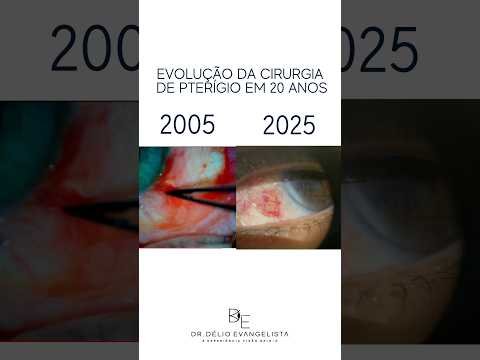 Evolução da cirurgia de pterígio em 20 anos
