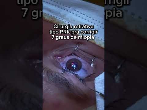 Cirurgia refrativa 100% a laser tipo PRK