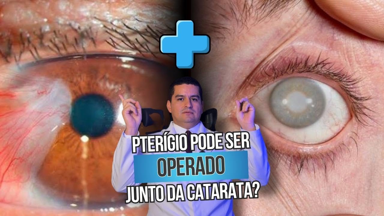 Pterígio e catarata podem ser operados ao mesmo tempo?