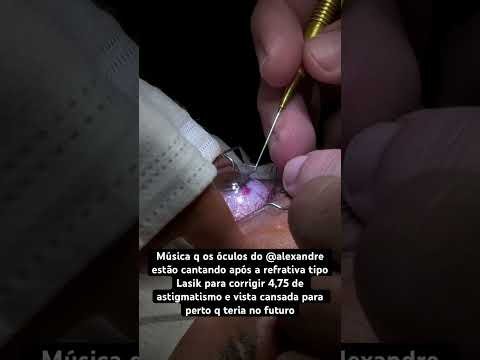 Refrativa Tipo Lasik: 4,75 de astigmatismo