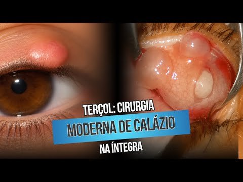 Terçol: Cirurgia Moderna de Calázio na íntegra