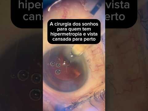 Cirurgia refrativa dos sonhos pra quem hipermetropia