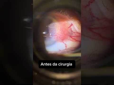 Cirurgia para câncer no olho…
